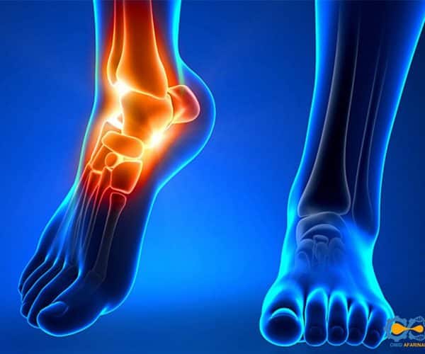 پرینت سه بعدی مفصل مچ پا